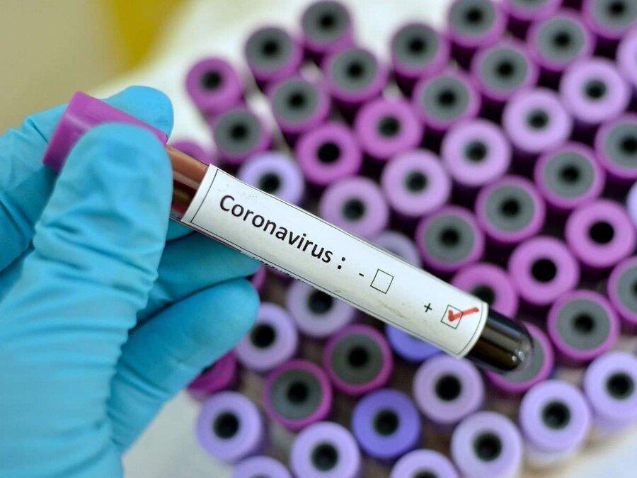 فیلم ، جدیدترین گزارش ها از ویروس مرموز ؛ افزایش قربانیان و شروع درمان با داروی ایدز
